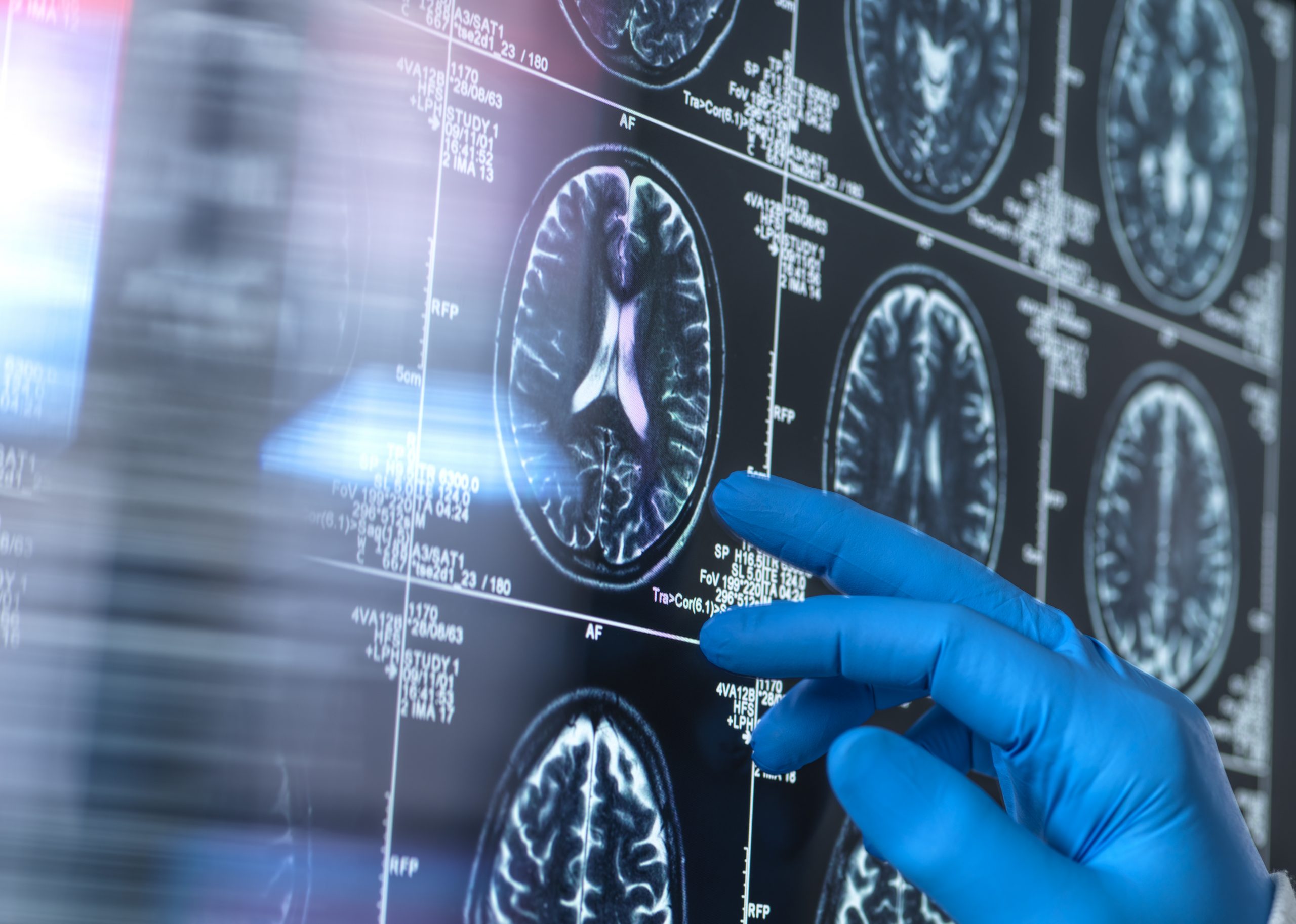 Un análisis de sangre abre nuevas posibilidades para detectar antes el Alzheimer